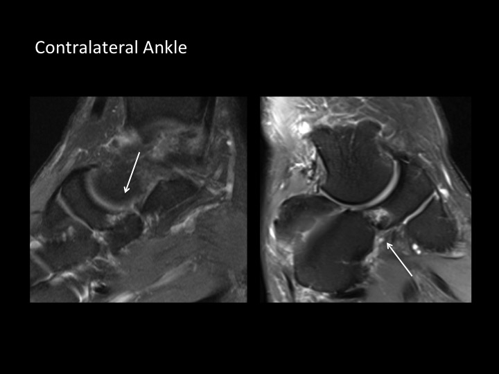 Figure 5 for case navicular-cuboid coalition